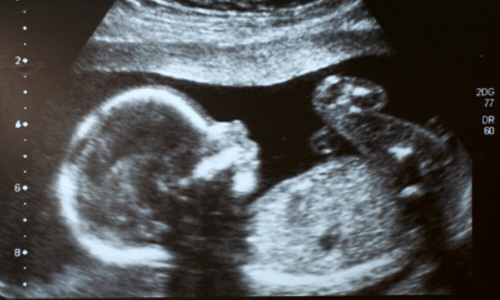 Ultrasound image of fetus at 22 weeks